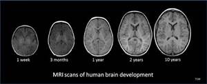 Brain development MRIs